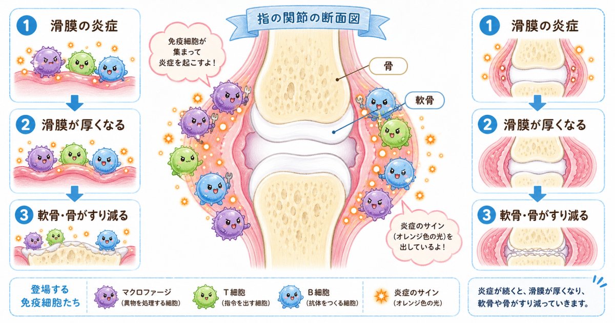 関節リウマチを疑う初期症状と朝のこわばりの特徴